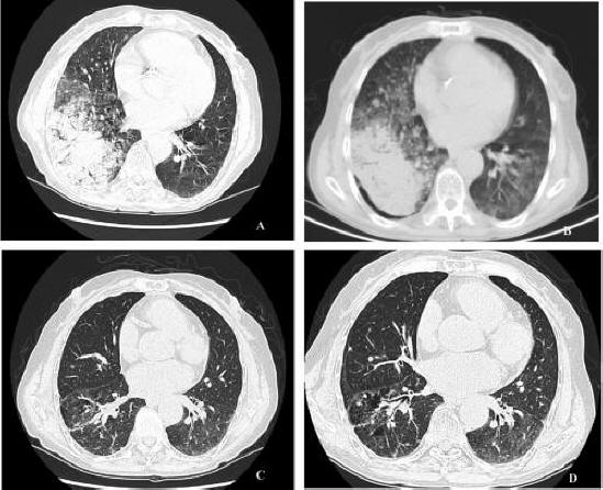Ct+scan+chest+nodule