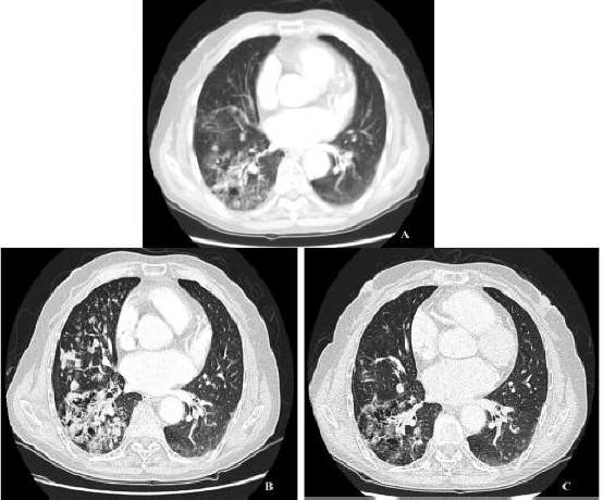 Ct+scan+chest+nodule