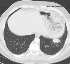 Normal+ct+scan+abdomen