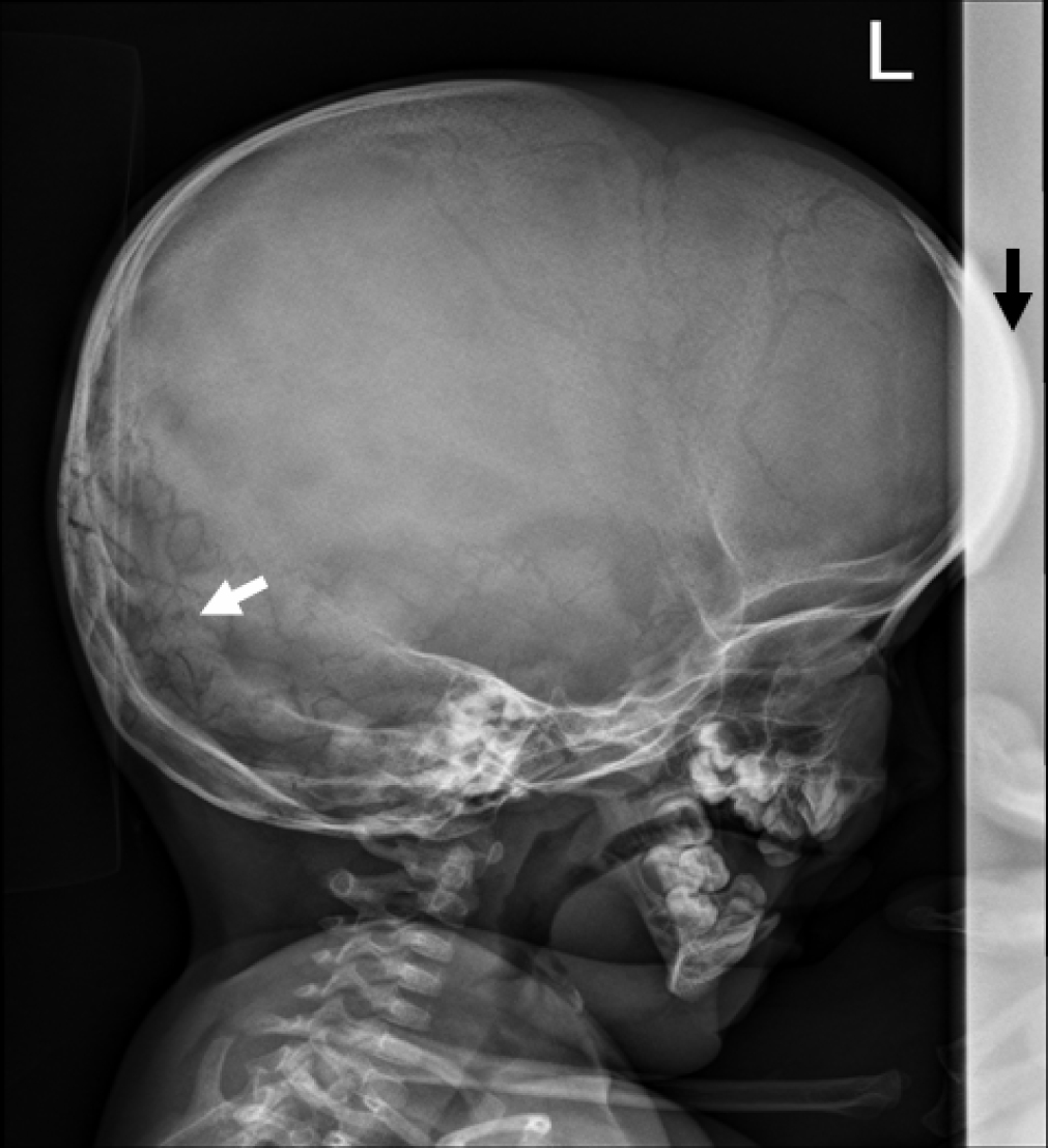 Mid-diaphyseal Endosteal Thickening With Subsequent Medullary Narrowing
