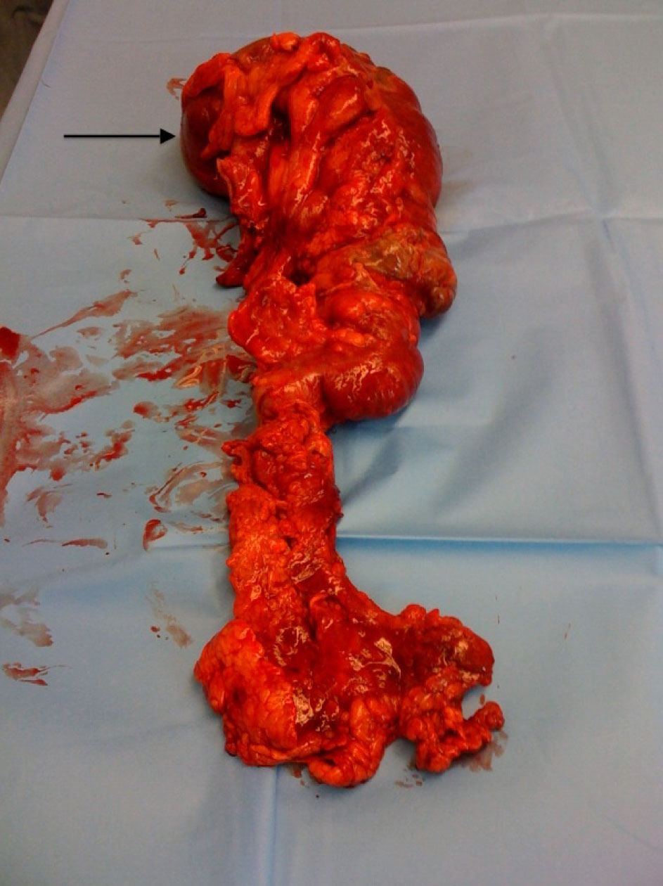 Images of Cecal Volvulus From a Strangulating Fallopian