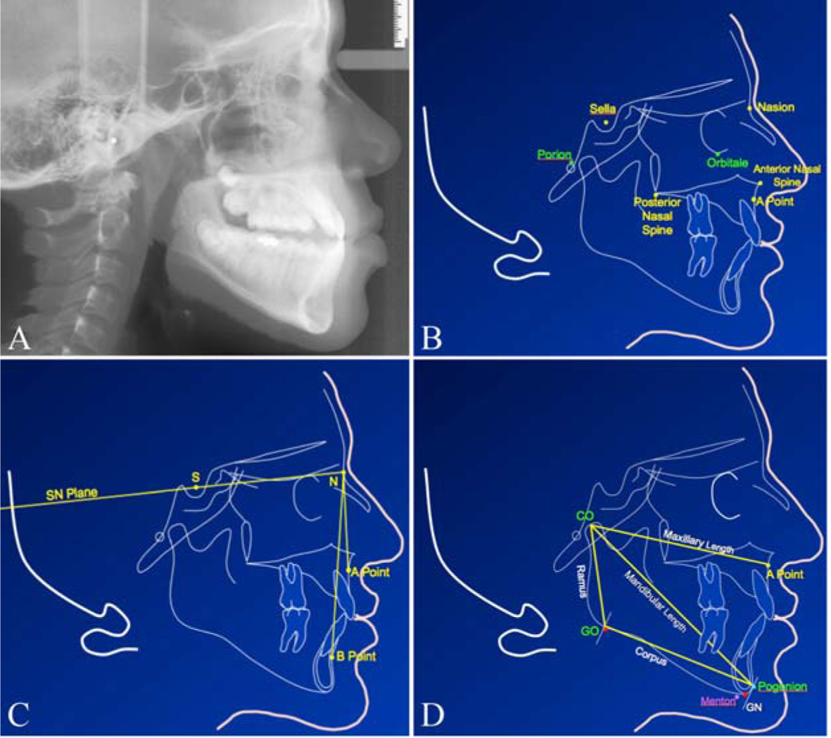 skeletal malocclusion