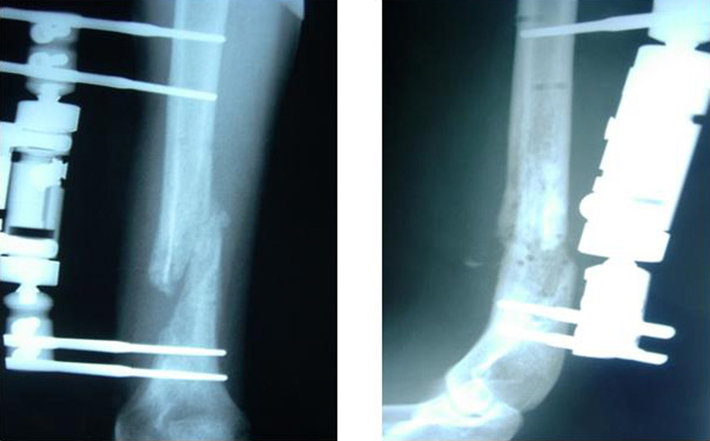 refacerea articulației umărului cu artroză ligamentele și articulațiile genunchiului