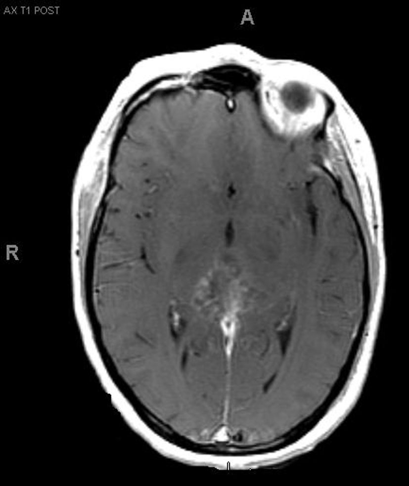 Atypical Teratoid/Rhabdoid Tumors in Adults: A Case Report and ...